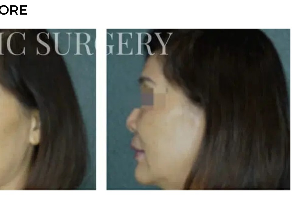 Procedure before and after - after