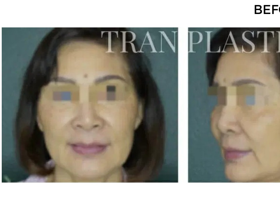 Procedure before and after - before