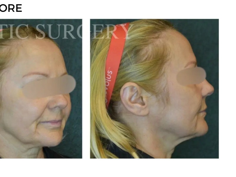 Procedure before and after - after