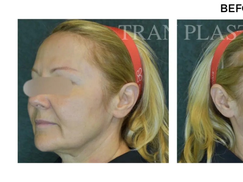 Procedure before and after - before