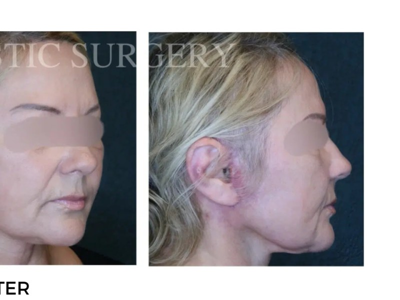 Procedure before and after - after