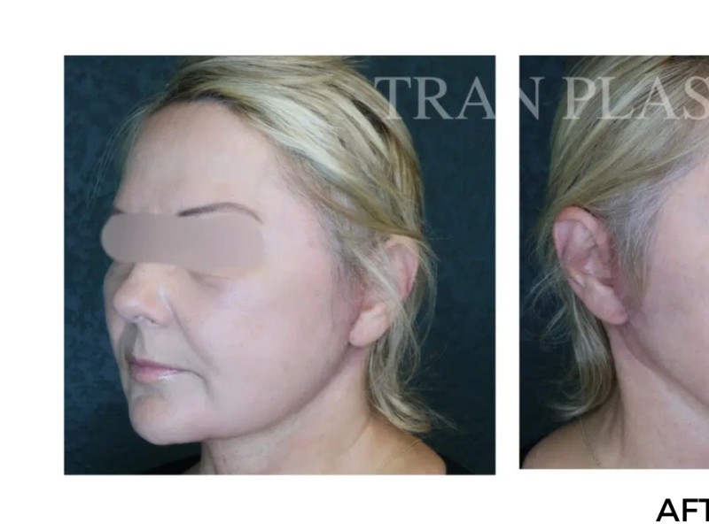 Procedure before and after - before