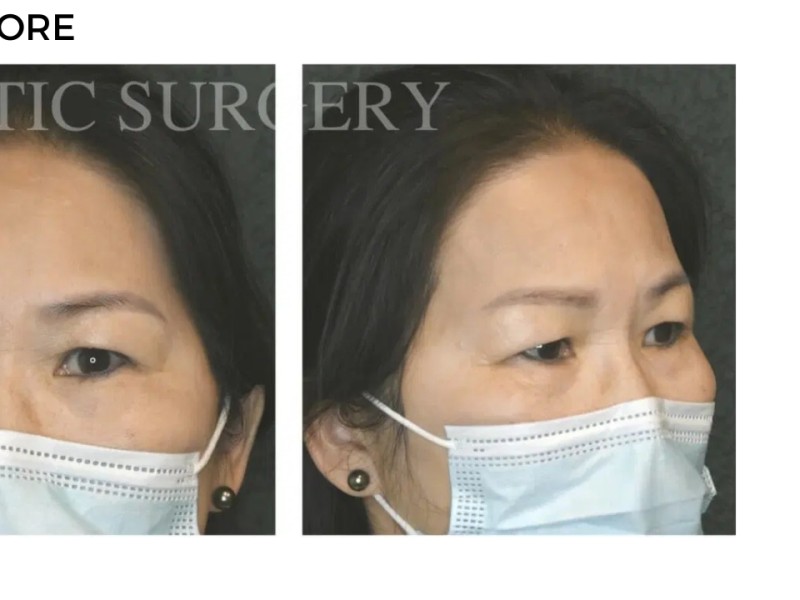 Procedure before and after - after