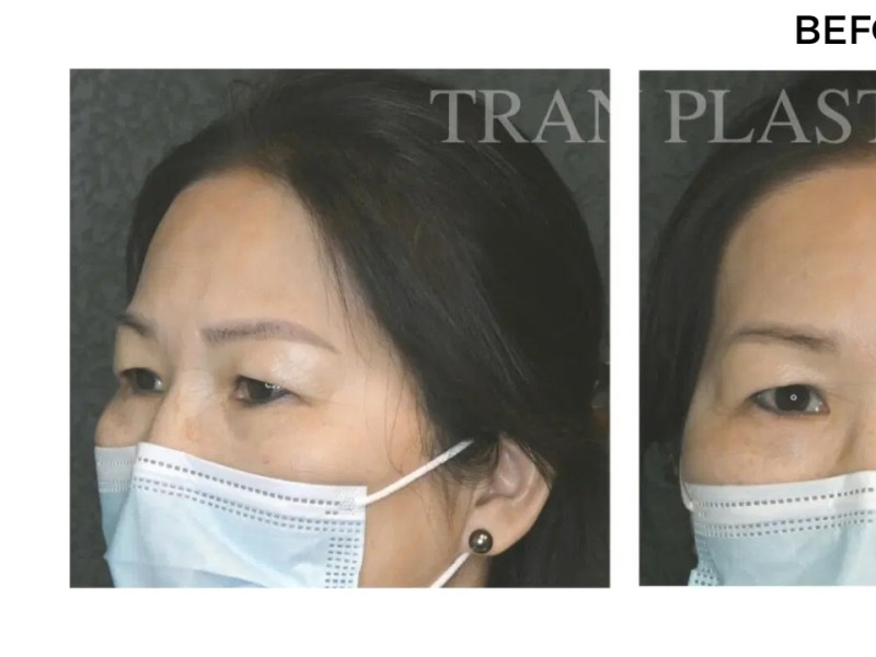 Procedure before and after - before