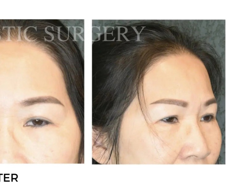 Procedure before and after - after