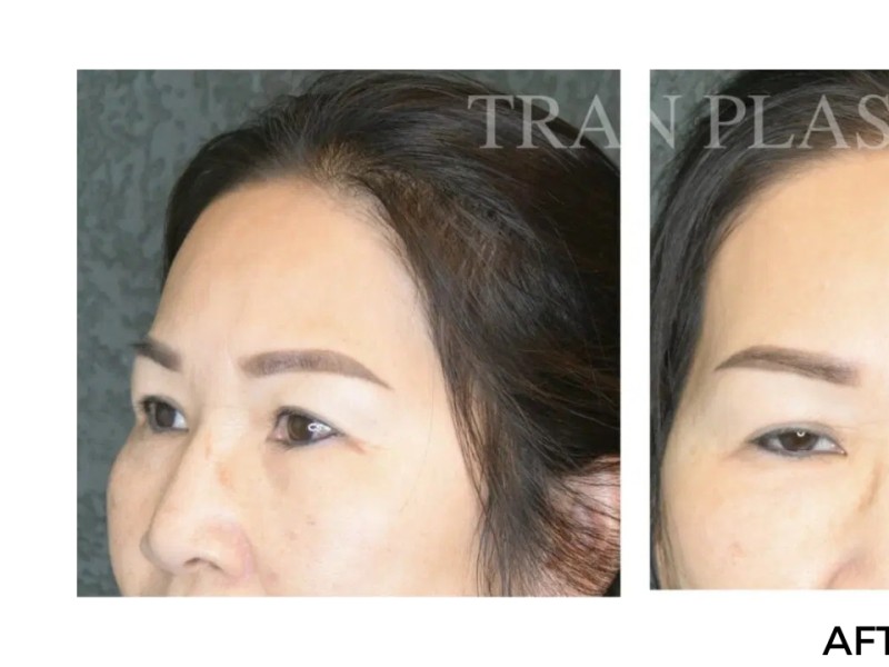 Procedure before and after - before