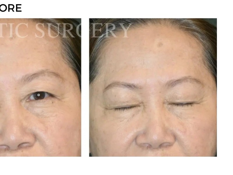 Procedure before and after - after