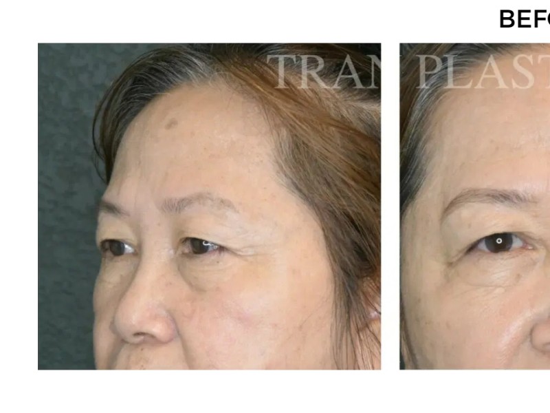 Procedure before and after - before