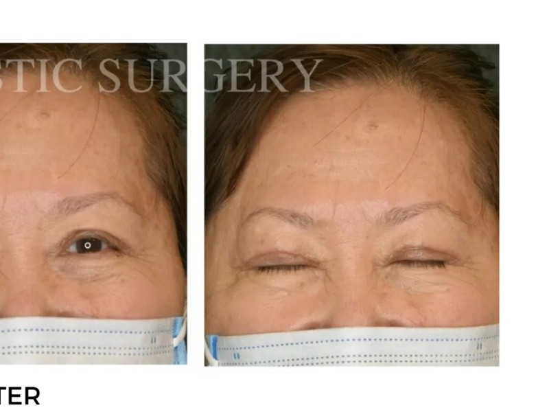 Procedure before and after - after
