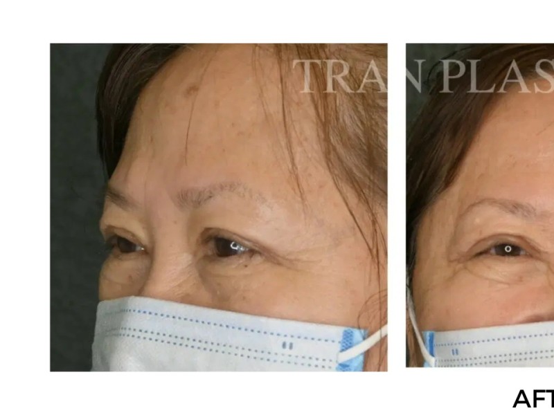 Procedure before and after - before