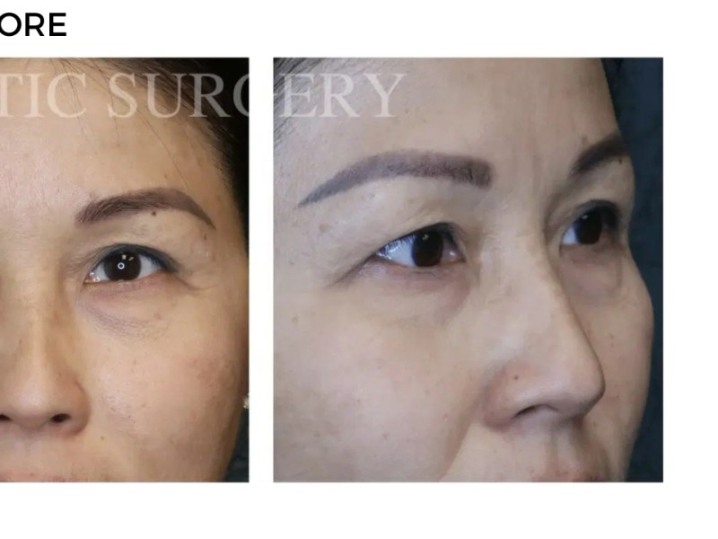 Procedure before and after - after