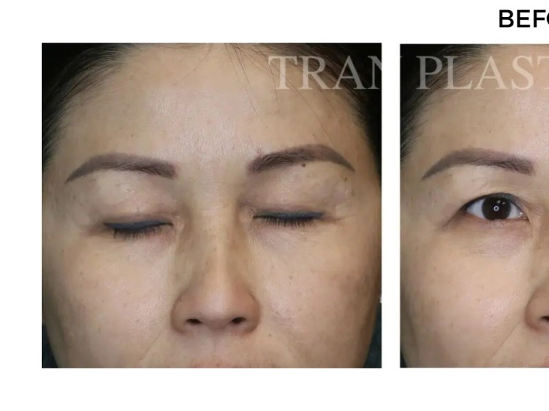 Procedure before and after - before