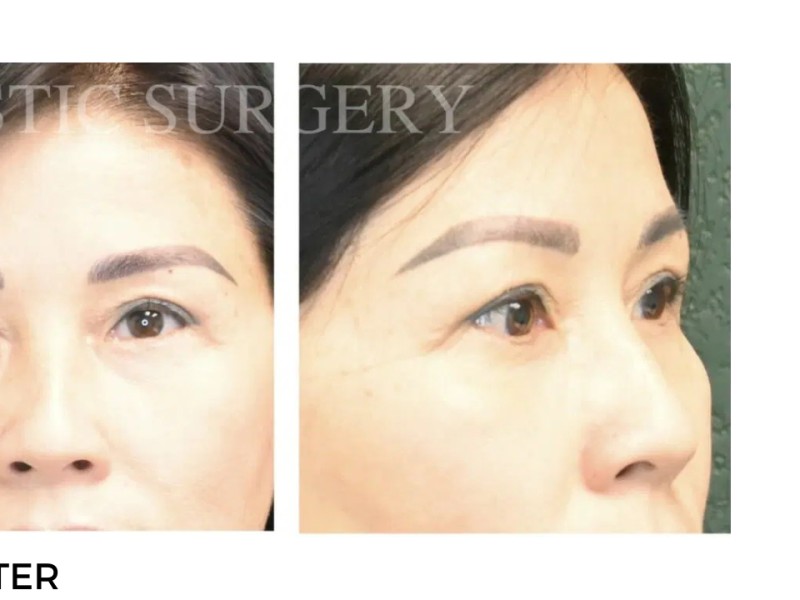 Procedure before and after - after
