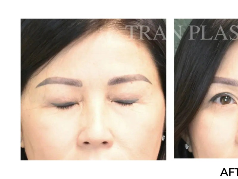 Procedure before and after - before