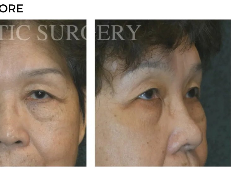 Procedure before and after - after