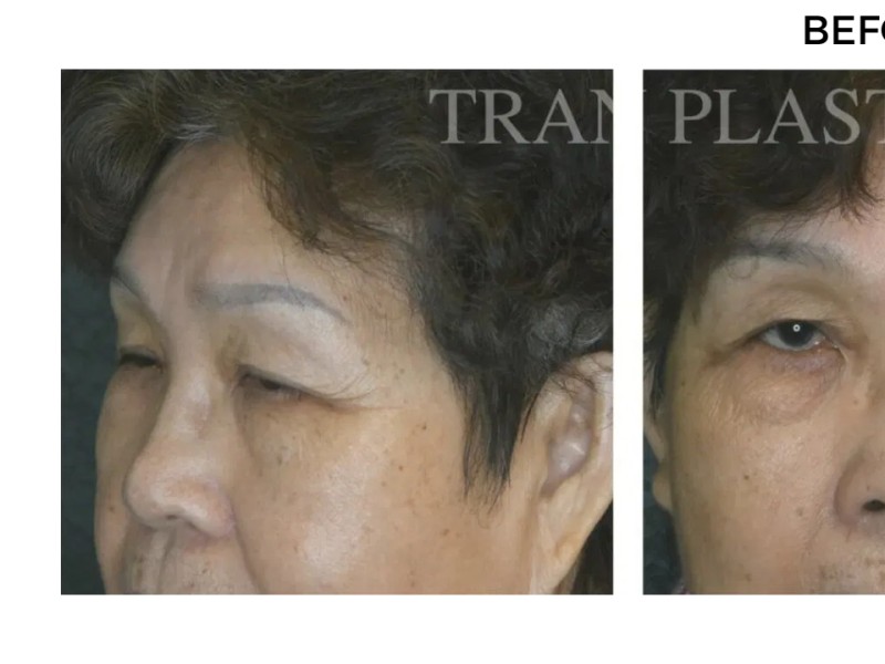 Procedure before and after - before