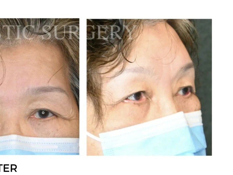 Procedure before and after - after
