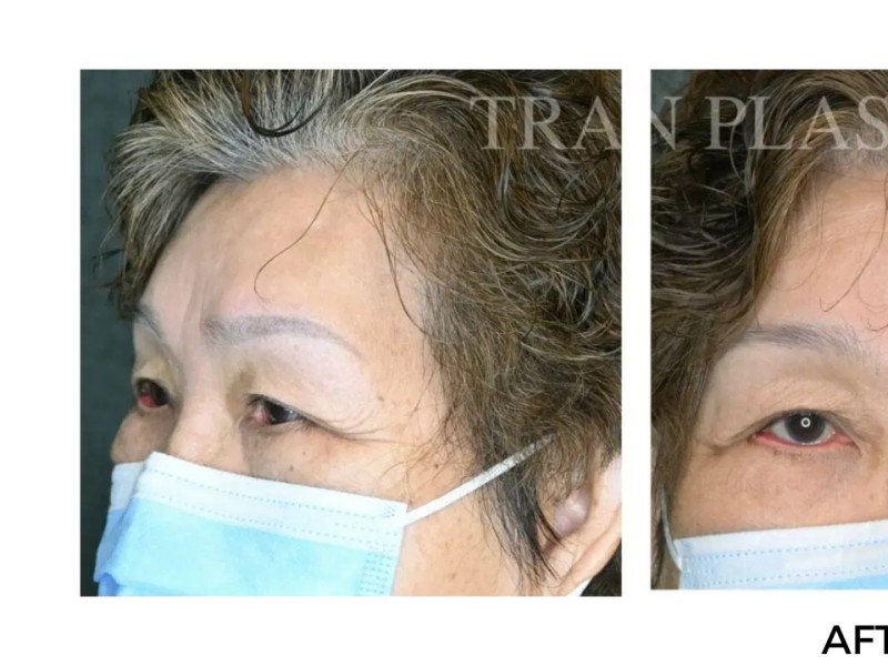 Procedure before and after - before