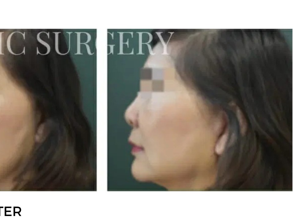 Procedure before and after - after