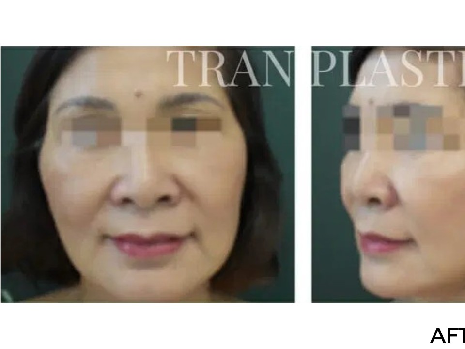 Procedure before and after - before