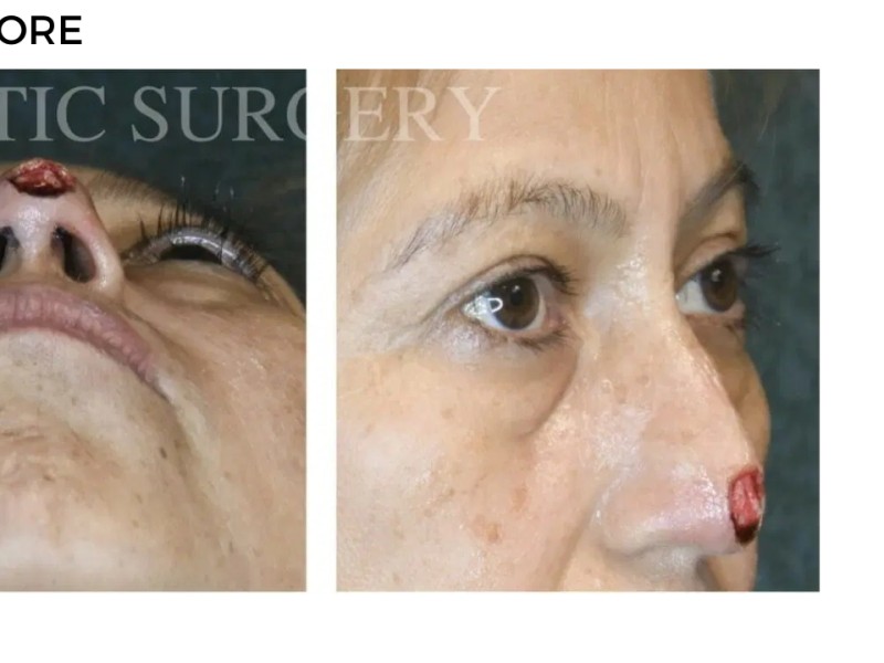Procedure before and after - after