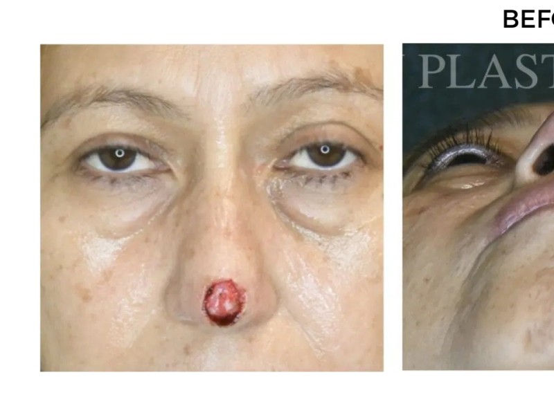 Procedure before and after - before