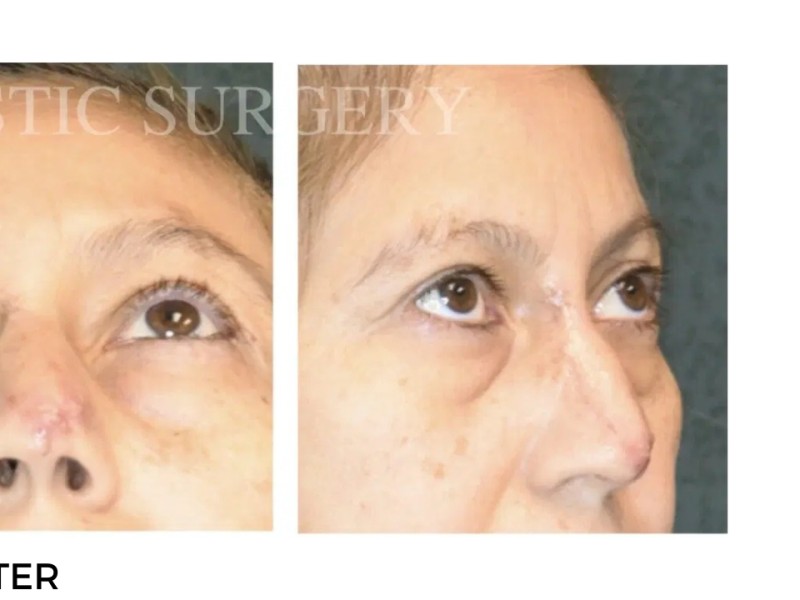 Procedure before and after - after