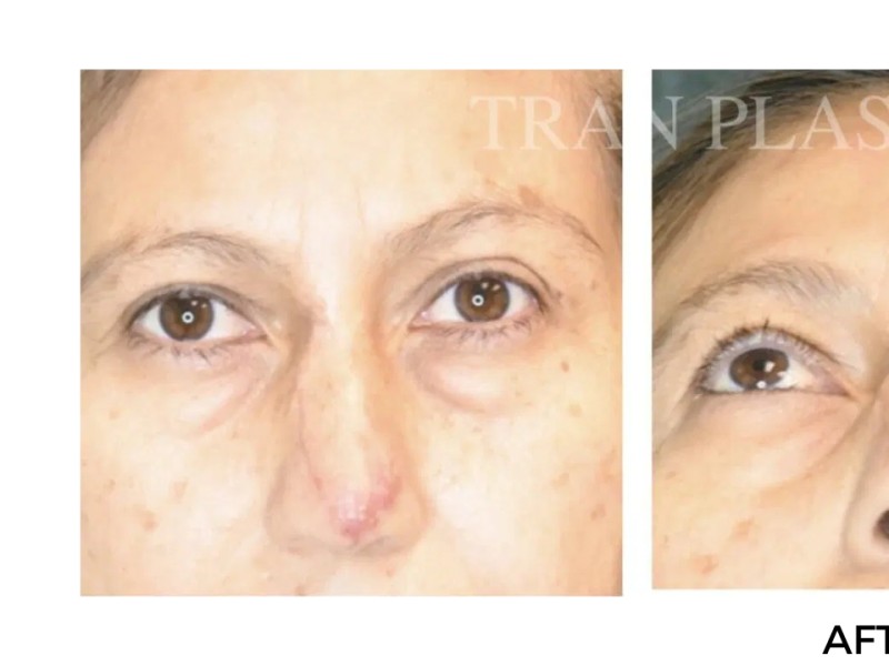 Procedure before and after - before