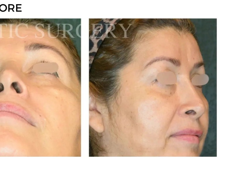 Procedure before and after - after