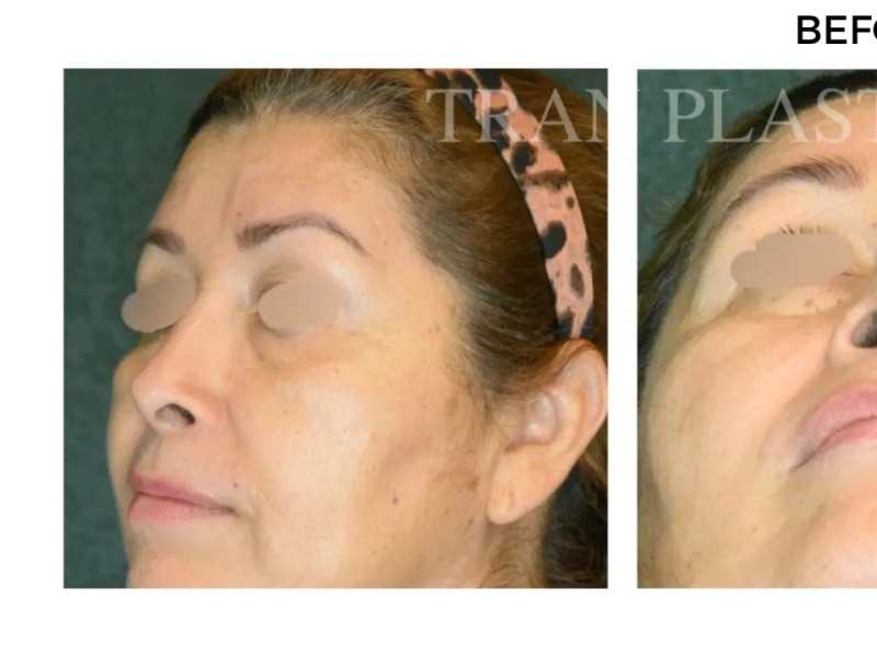 Procedure before and after - before