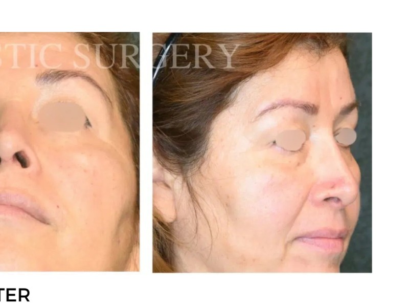 Procedure before and after - after