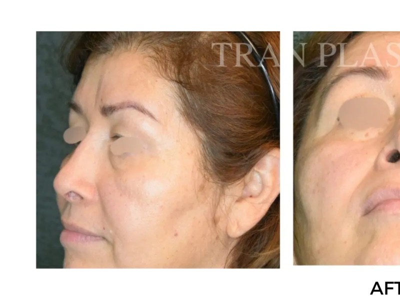Procedure before and after - before