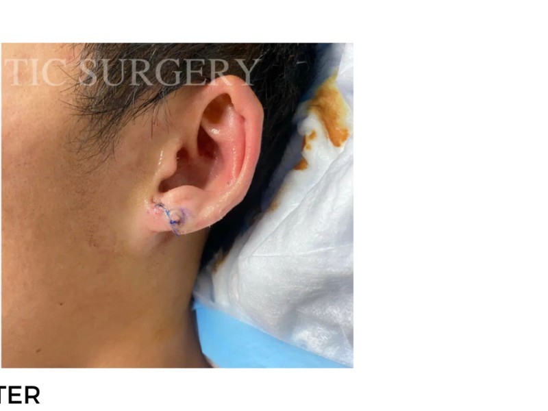 Procedure before and after - after