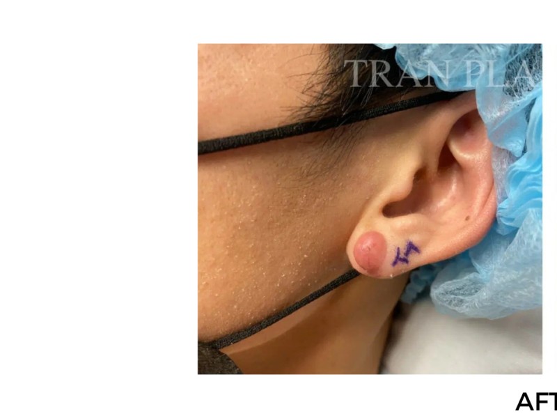 Procedure before and after - before