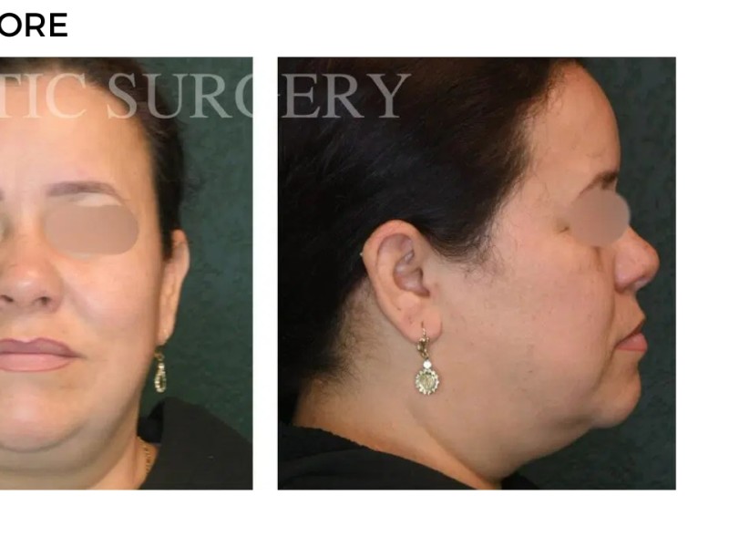 Procedure before and after - after
