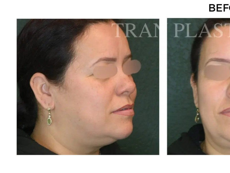 Procedure before and after - before