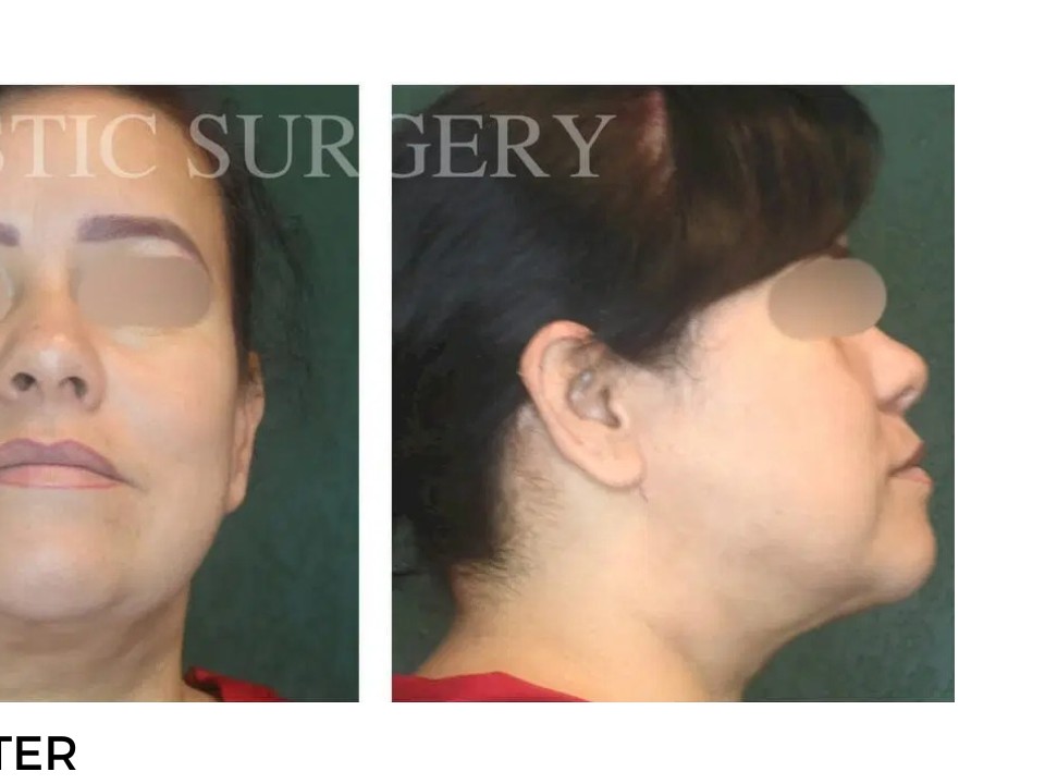 Procedure before and after - after
