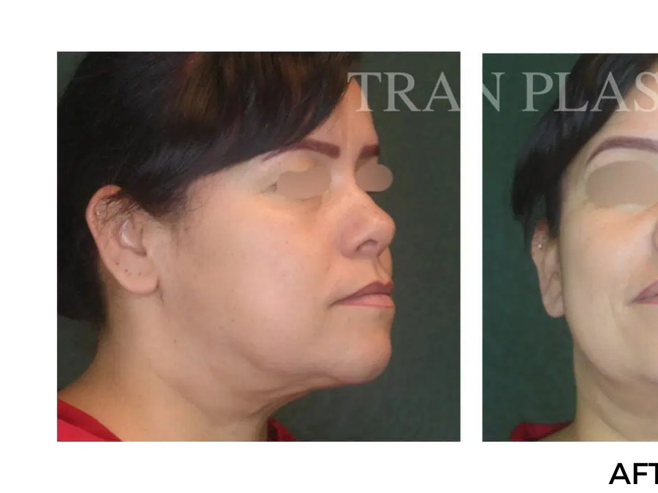 Procedure before and after - before