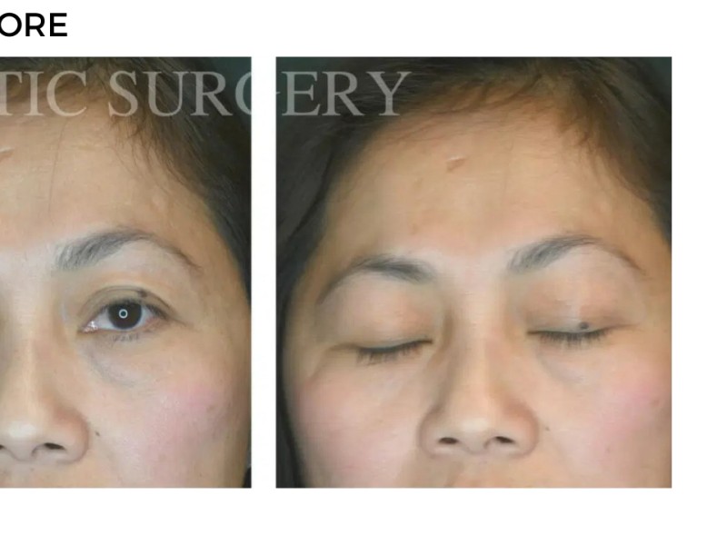 Procedure before and after - after