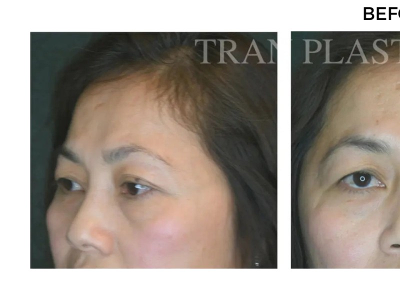 Procedure before and after - before