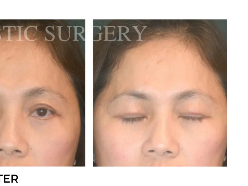 Procedure before and after - after