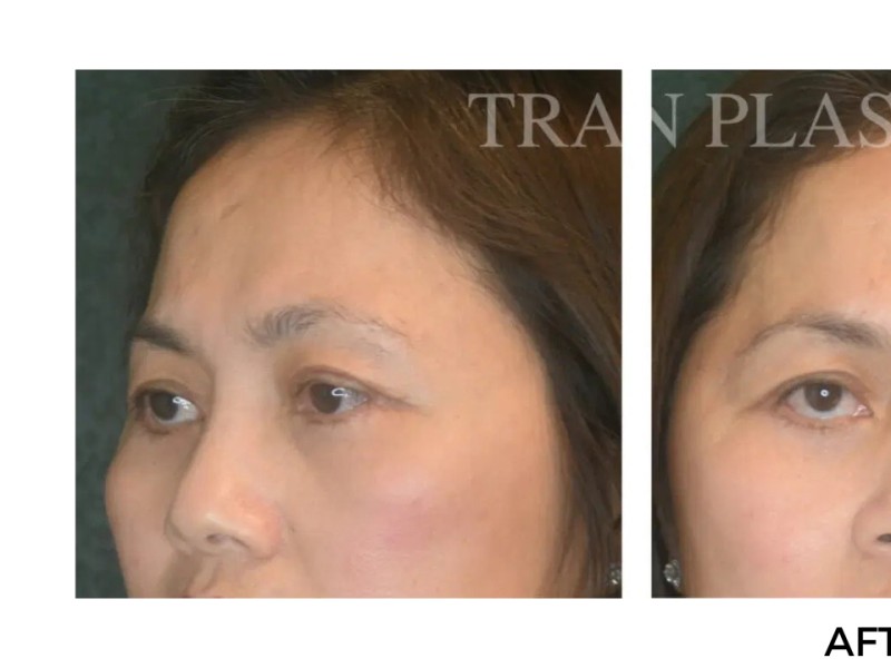 Procedure before and after - before
