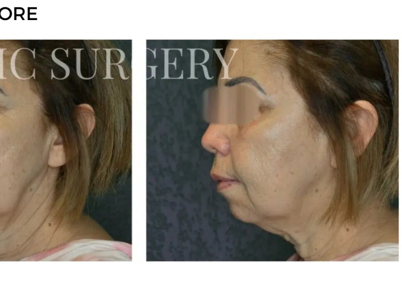 Procedure before and after - after