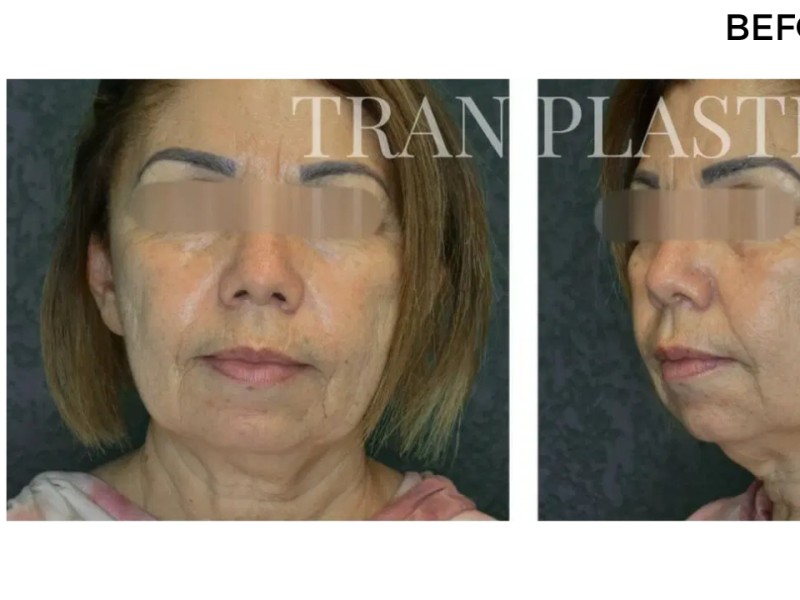 Procedure before and after - before