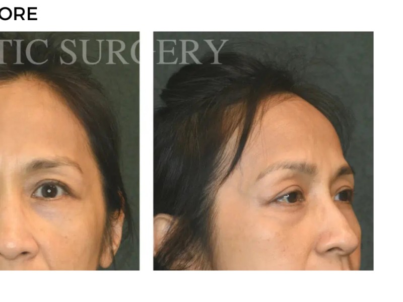 Procedure before and after - after