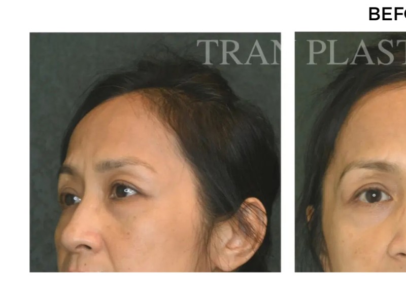 Procedure before and after - before