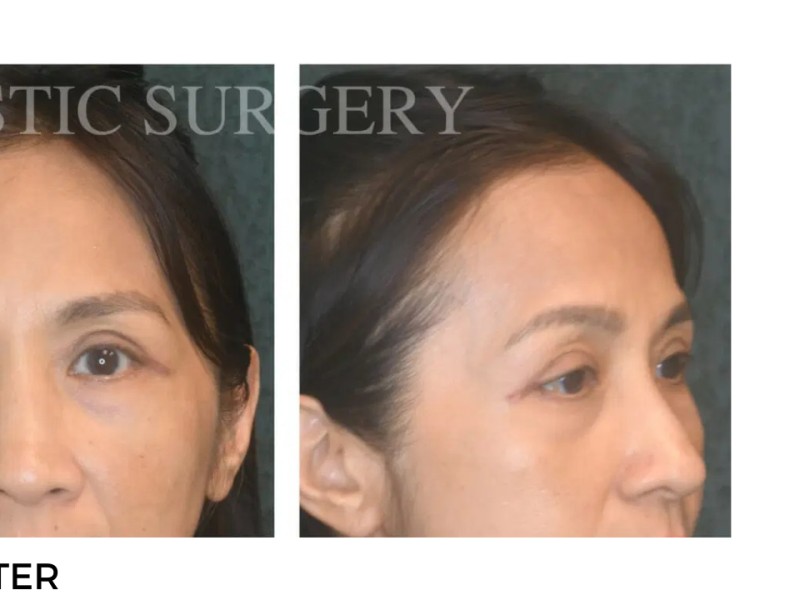 Procedure before and after - after