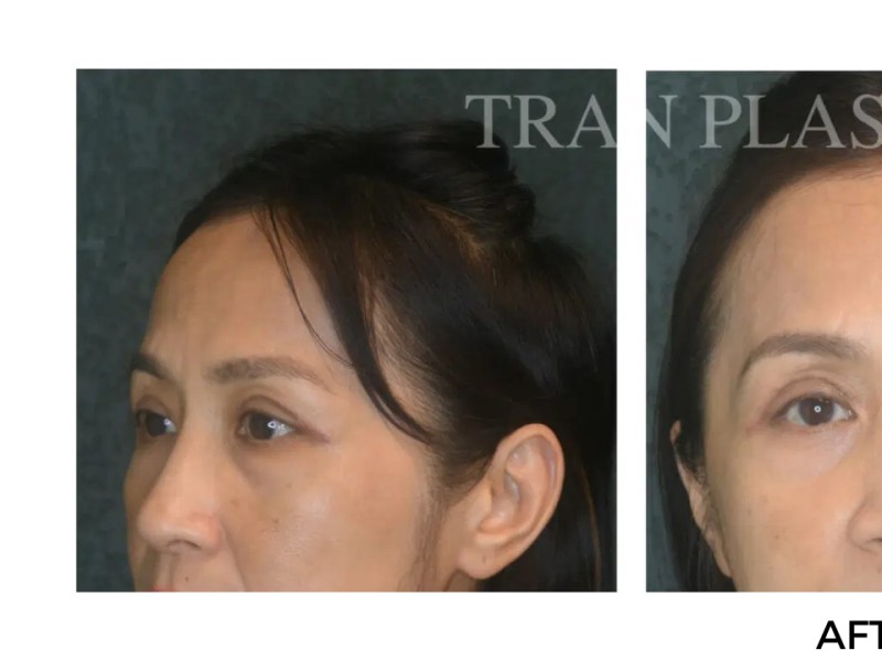 Procedure before and after - before