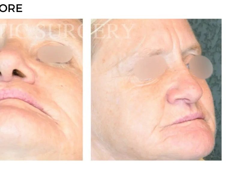 Procedure before and after - after
