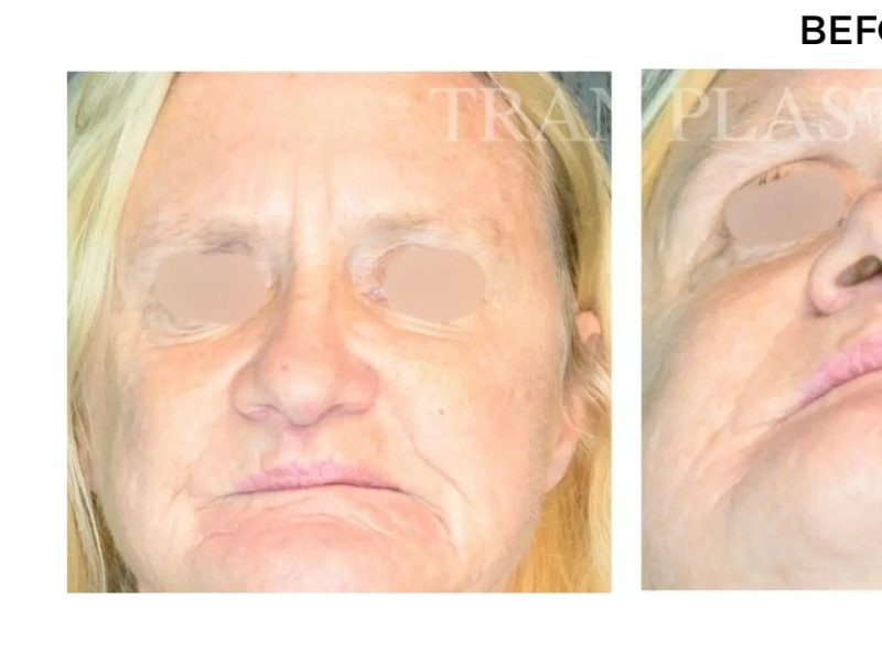 Procedure before and after - before